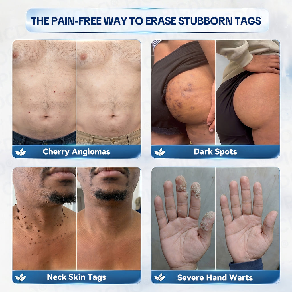 7 Day Skin Tag Remover