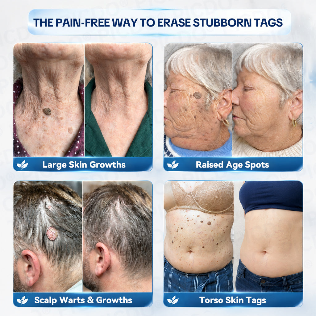 Skin Tag Remover Cream