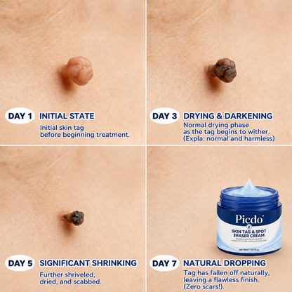 7 Day Skin Tag Remover