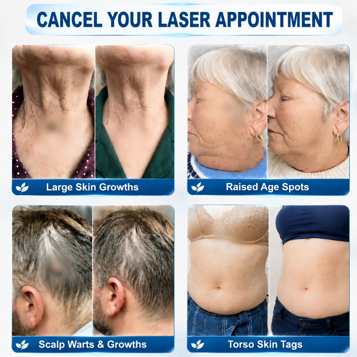 𝐄𝐦𝐞𝐦𝐚𝐱®𝟐-𝐢𝐧-𝟏 𝐌𝐢𝐜𝐫𝐨𝐧𝐞𝐞𝐝𝐥𝐞 & 𝐇𝐲𝐝𝐫𝐨𝐜𝐨𝐥𝐥𝐨𝐢𝐝 𝐌𝐨𝐥𝐞 𝐑𝐞𝐦𝐨𝐯𝐚𝐥 𝐏𝐚𝐭𝐜𝐡(Zero Pain, Zero 𝐒𝐜𝐚𝒓𝒔 patch)💪