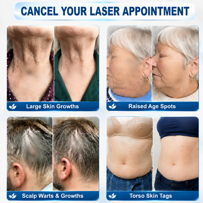 𝐄𝐦𝐞𝐦𝐚𝐱®𝟐-𝐢𝐧-𝟏 𝐌𝐢𝐜𝐫𝐨𝐧𝐞𝐞𝐝𝐥𝐞 & 𝐇𝐲𝐝𝐫𝐨𝐜𝐨𝐥𝐥𝐨𝐢𝐝 𝐌𝐨𝐥𝐞 𝐑𝐞𝐦𝐨𝐯𝐚𝐥 𝐏𝐚𝐭𝐜𝐡(Zero Pain, Zero 𝐒𝐜𝐚𝒓𝒔 patch)💪