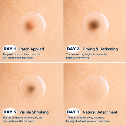𝐄𝐦𝐞𝐦𝐚𝐱®𝟐-𝐢𝐧-𝟏 𝐌𝐢𝐜𝐫𝐨𝐧𝐞𝐞𝐝𝐥𝐞 & 𝐇𝐲𝐝𝐫𝐨𝐜𝐨𝐥𝐥𝐨𝐢𝐝 𝐌𝐨𝐥𝐞 𝐑𝐞𝐦𝐨𝐯𝐚𝐥 𝐏𝐚𝐭𝐜𝐡(Zero Pain, Zero 𝐒𝐜𝐚𝒓𝒔 patch)💪