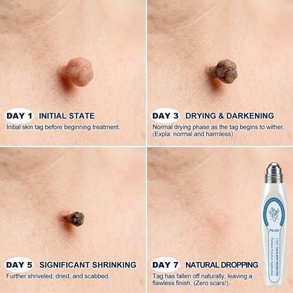 𝐏i𝐜𝐝o® 7-𝐷𝑎𝑦 𝗧𝐚𝐠 & 𝗦𝗽𝐨𝐭 𝐄𝐫𝒂𝒔𝒆𝒓(Zero Pain, Zero 𝐒𝐜𝐚𝒓𝒔 Rollerball)💪
